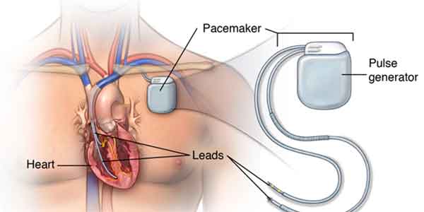 تاثیر ماکروویو روی باطری قلب با Pacemaker